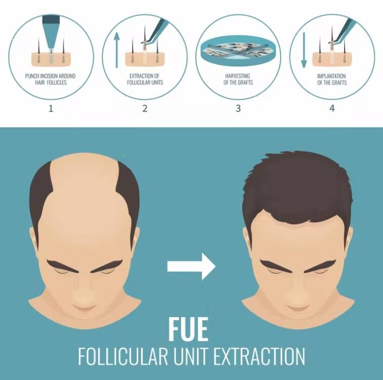 Fue Haar implantat Mikro motor – Hair Care Basic Bewertung und Preis